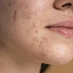 Acne Treatment and solution
