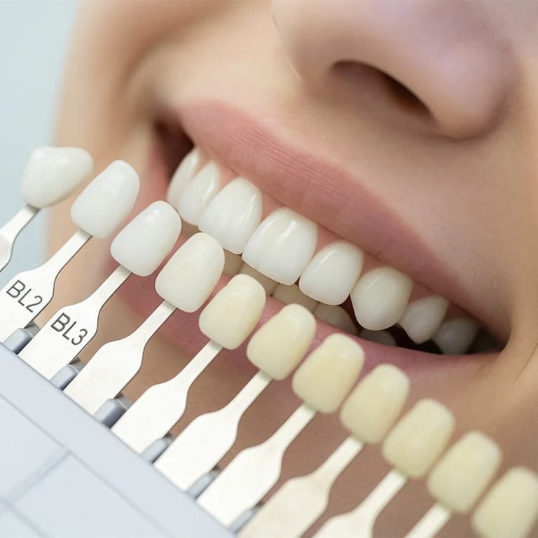 Dental-veneers-and-Laminates