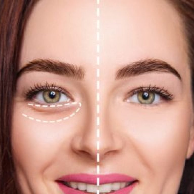 Eye-Under-Bags-Treatment-1812624067-300x271