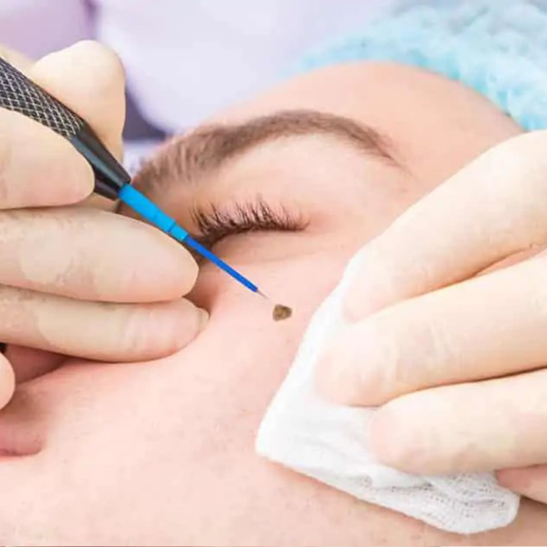 Wart, skin tag, & mole removal