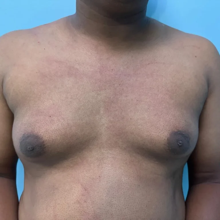 Gynecomastia Correction