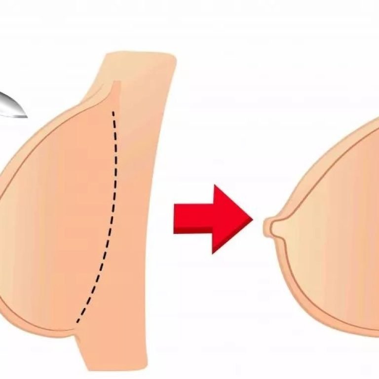 breast-augmentation-queensland-price-1024x533